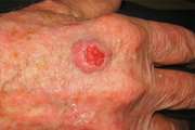 سرطان سلول‌های سنگفرشی یک نوع سرطان پوست